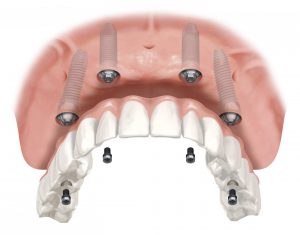 Illustration: All-on-4® Treatment Concept front view
