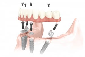 Illustration: All-on-4® Treatment Concept side view